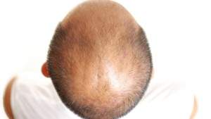 enzyme-baldness-2