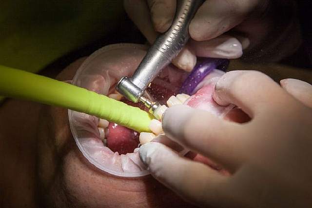 Учёные обнаружили лекарственный препарат, который залечивает кариозные полости и регенерирует зубы