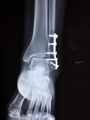 Новый имплантат исцеляет сломанные ноги, превращаясь в настоящую кость