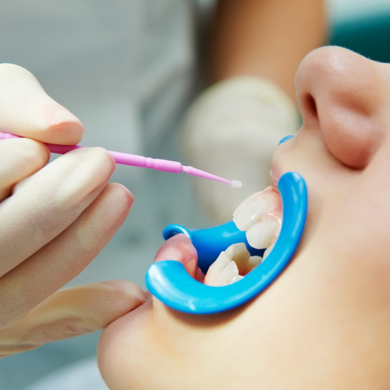 Фторирование зубов: защита здоровья рта и улучшение качества жизни