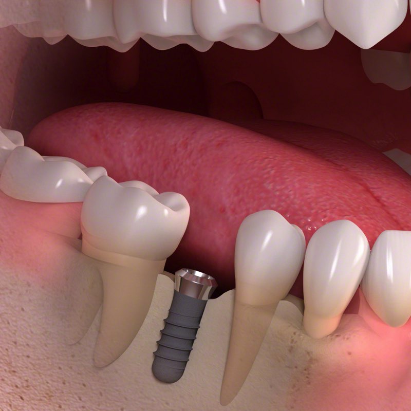 Описание процесса полной имплантации зубов